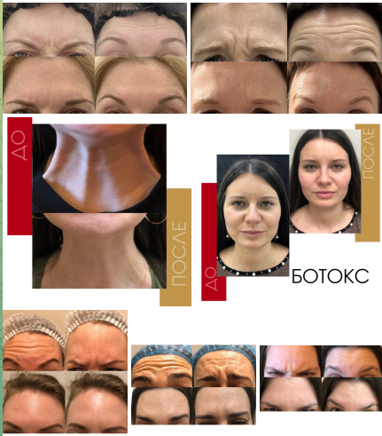 Ботулинотерапия — до и после